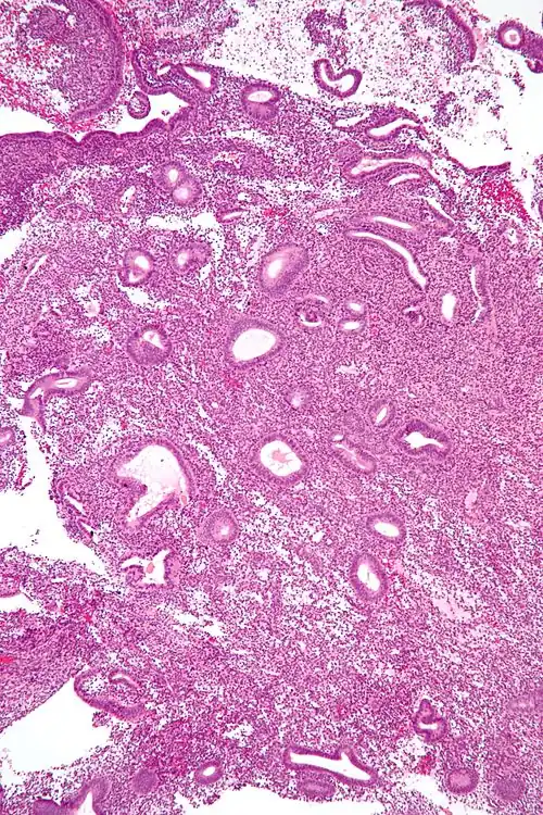 Micrograph showing an endometrial biopsy with endometrial hyperplasia, where the gland-to-stroma ratio is preserved but the glands have an irregular shape and/or are dilated