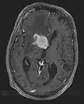 MRI T1 Axial