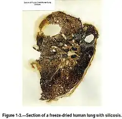 Lung of a patient with Silicosis showing severe scarring