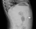 Lateral X ray showing a 9mm battery in the intestines