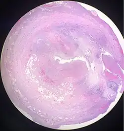 Acute suppurative appendicitis with perforation (at right). H&E stain.
