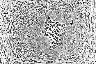 Light micrograph of undecalcified tissue displaying osteoblasts actively synthesizing rudimentary bone tissue (center)