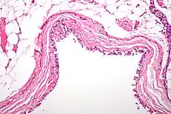 Histological micrographic image of a bronchogenic cyst of the mediastinum. Sample has been stained with hematoxylin and eosin to improve contrast.