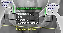 Center of rotation: The horizontal center of rotation is calculated as the distance between the acetabular teardrop and the center of the head (or caput) of the prosthesis and/or the native femoral head on the contralateral side.[95] The vertical center of rotation instead uses the transischial line for reference.[95] The parameter should be equal on both sides.[95]