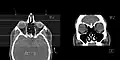 CT scan of the paranasal sinuses with coronal reconstruction (right) and axial planning data (left).