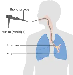 Diagram of a machine attached to a tube running down a person's mouth and into their trachea and bronchi