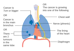 One option for stage IIB lung cancer, with T2b; but if tumor is within 2 cm of the carina, this is stage 3