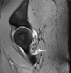 Sagittal T2* gradient echo image showing a posterior soft tissue mass with hypointense areas secondary to hemosiderin deposition.[1]