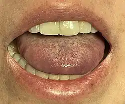 Elevated tongue due to Ludwig's angina