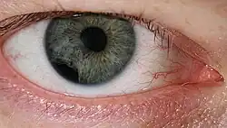 A blue eye shown with iris partially moved into the pupil from the outside edge.