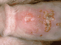 Genital herpes in men. Vesicles, ulcers and crusts on the Penis