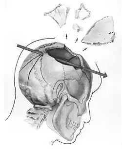 Another sketch shows an arrow illustrating the second bullet that fatally hit Kennedy in the head. Fragments are shown breaking from his skull.