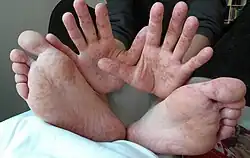 Rash on hands and feet of a 36-year-old man