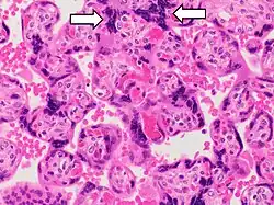 Histopathology of placenta with increased syncytial knotting of chorionic villi, with two knots pointed out.