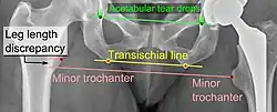 Leg length discrepancy after hip replacement is calculated as the vertical distance between the middle of the minor trochanters, using the acetabular tear drops[95] or the transischial line[16] as references for the horizontal plane. A discrepancy of up to 1 cm is generally tolerated.[95][16]