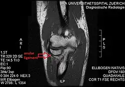 T1 weighted MRI showing the anular ligament