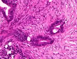 Moderately-to-poorly differentiated colorectal carcinoma