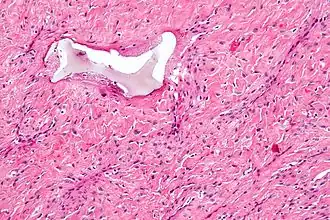 High magnification micrograph of a nasopharyngeal angiofibroma.