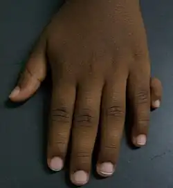 Type 1 ulnar polydactyly. An extra digit is attached by skin and nerves.