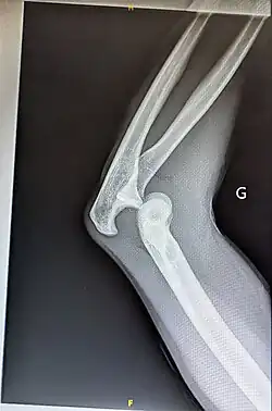X-ray of left elbow posterior joint dislocation without fracture