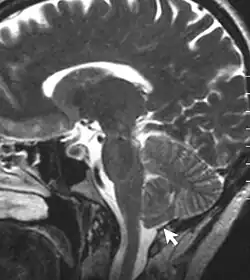 An MRI image of Chiari malformation
