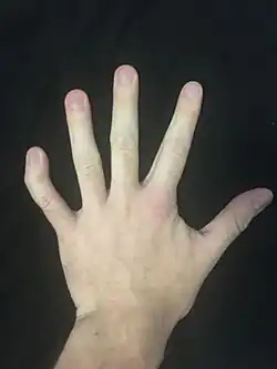 Photograph of a left hand showing severe clinodactyly on the fifth finger.