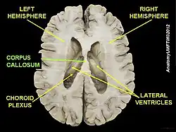 Corpus callosum