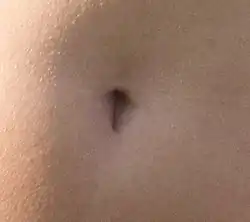 A "T"-shaped "innie" navel