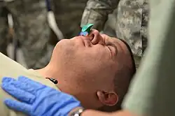 A nasopharyngeal airway inserted in the right nostril of a patient.