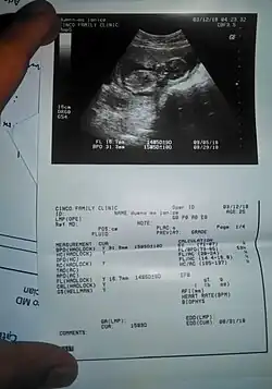 An ultrasound result on fetal biometry printed on a piece of paper