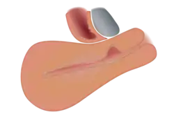 A uterus with a niche