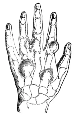 Fig. 10.—Multiple chondromata of the fingers.