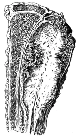 Fig. 12.—Ossifying periosteal sarcoma of fibula.