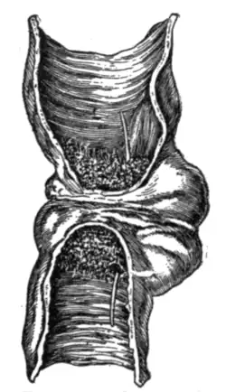 Fig. 17.—Cancer of the sigmoid flexure of the colon.