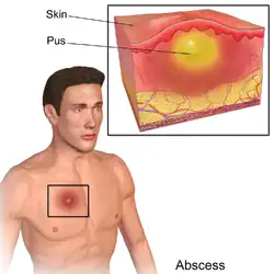An abscess in the dermis.
