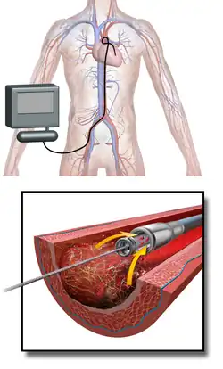 Coronary thrombectomy by AngioJet technique.