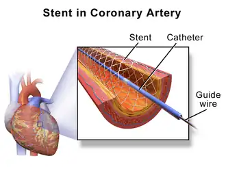 A coronary stent placed by percutaneous coronary intervention.