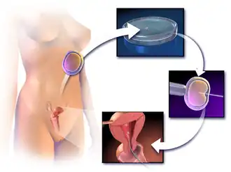 In vitro fertilization (IVF) with intracytoplasmic sperm injection (ICSI).