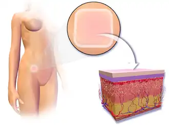 Contraceptive patch.