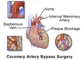Coronary artery bypass surgery.