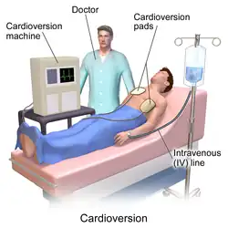 The setting of cardioversion