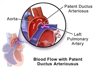 Patent ductus arteriosus.