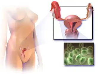 Pelvic inflammatory disease.
