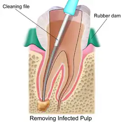Endodontic therapy of a root canal.