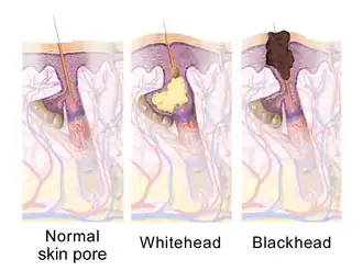 Sebaceous gland states.